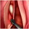 IPO Microcirurgia de Laringe
