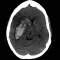HeRS - Hemorrhage Risk Stratification Calculator