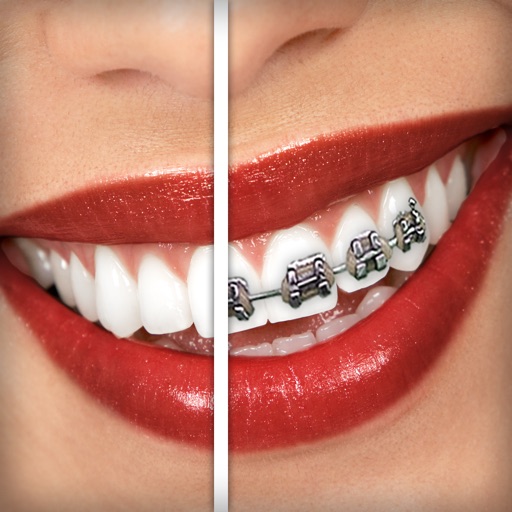 Brace Face Brace Face