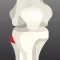 Peroneal Nerve Therapy