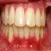 How To Fix An Overbite