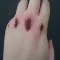 How To Get Rid Of Scabs