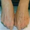 How To Remove Liver Spots