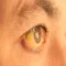 Symptoms Of Jaundice