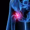 Septic Hip