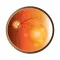 AMD & Anti-VEGF Therapy