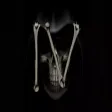 Broken Bones