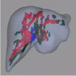 Child-Pugh (CP) Classification