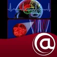 Stroke Prevention in AFib