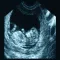 ARDMS OBGYN Ultrasound Flashcards for ARDMS OB/GYN Board Review