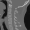 CT Cervical Spine