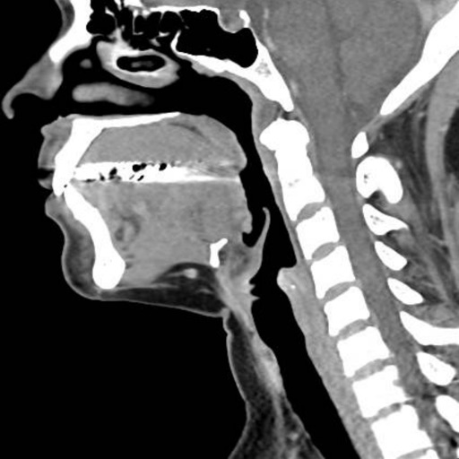 CT Neck CT Neck